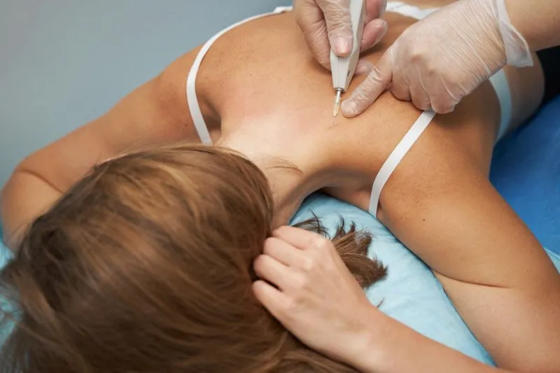 Carboksyterapia / karboksyterapia
